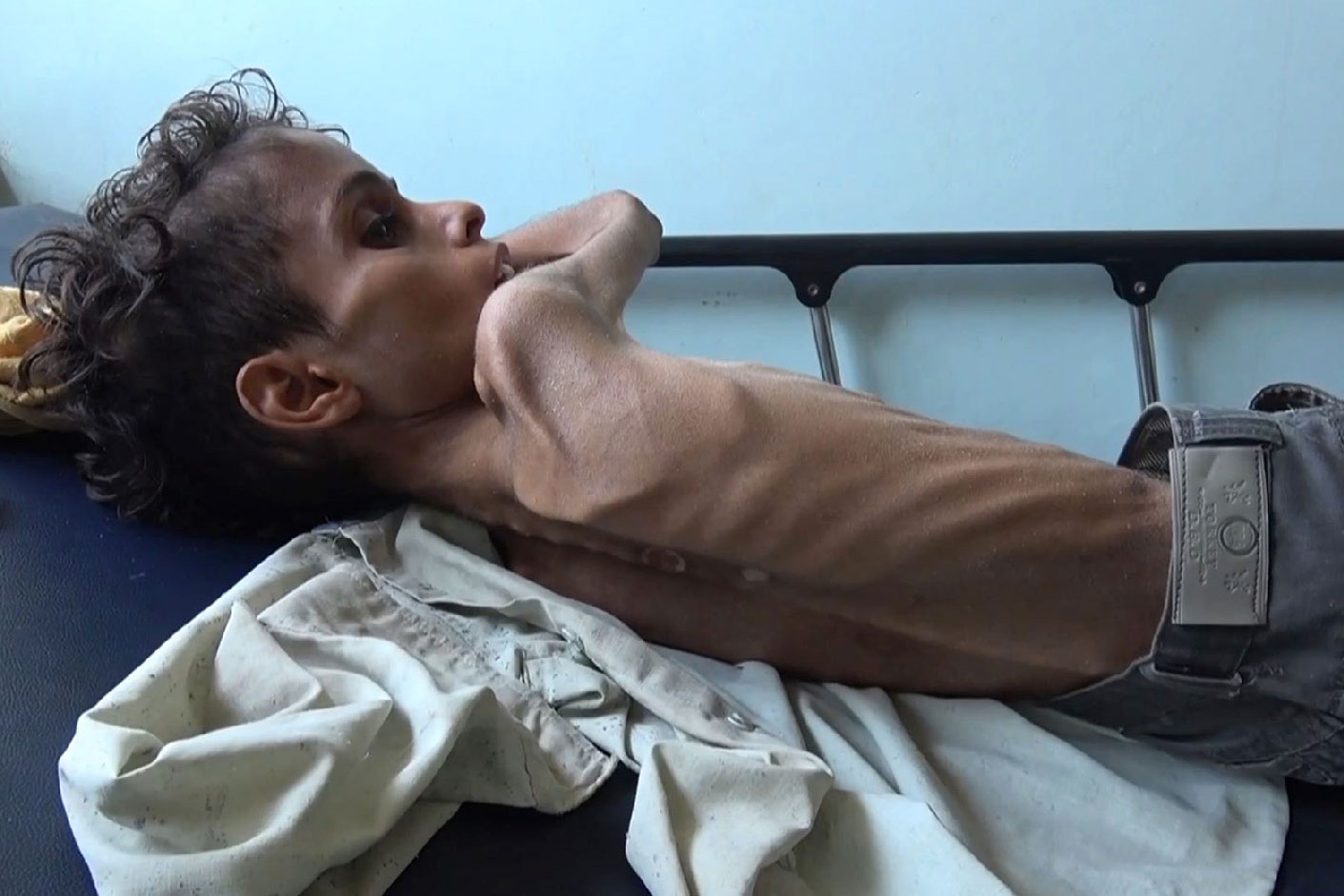 10 year-old Ghazi Saleh lies on a bed at Al-Mudhafar hospital in Taez on November 19, 2018.