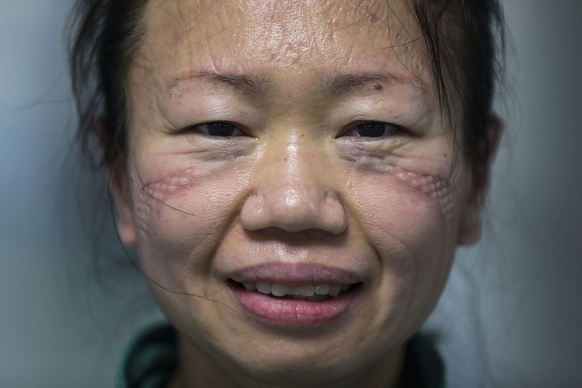 ممرضة في مستشفى بووهان تظهر على وجهها آثار ارتداء الكمامة الواقية