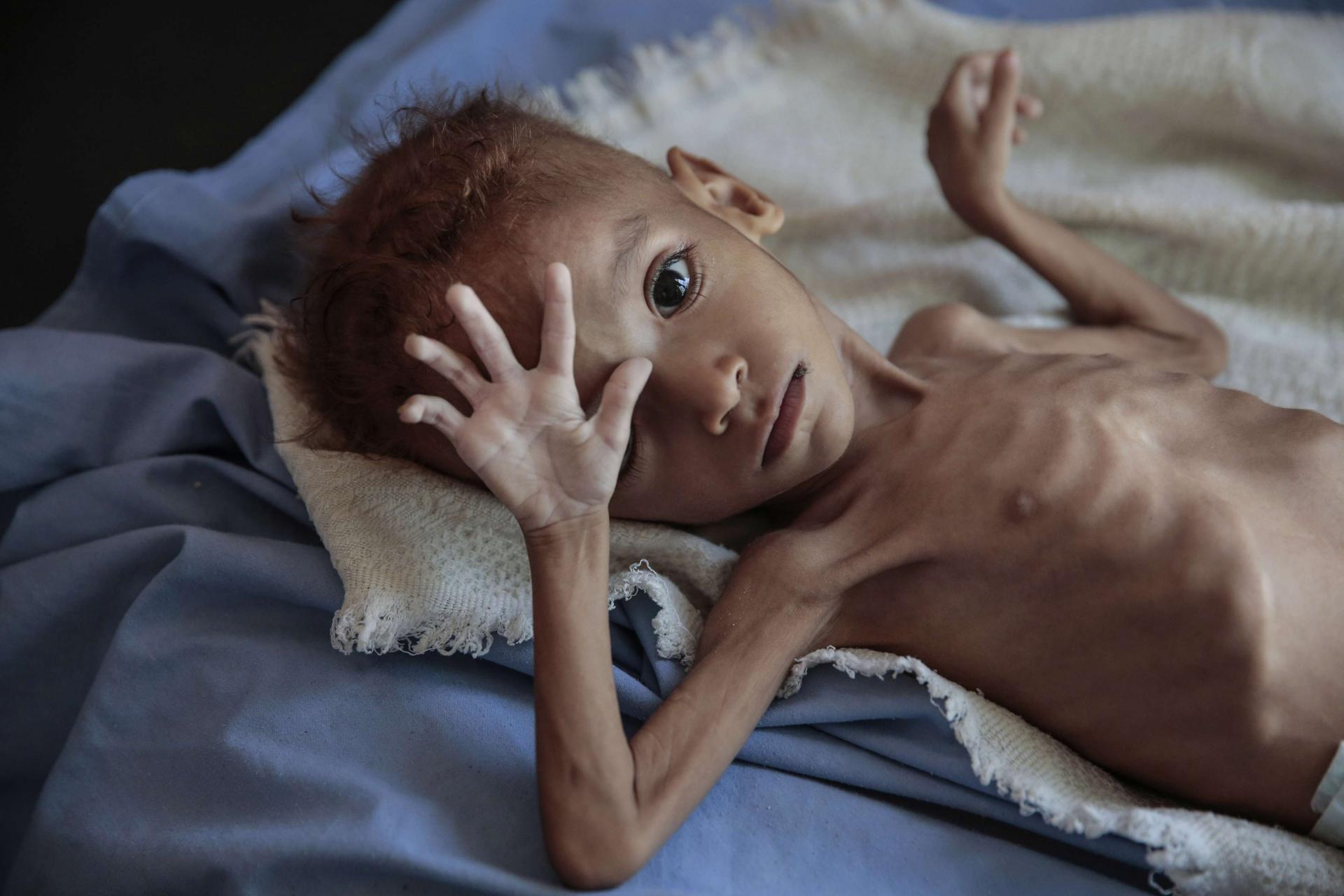 ملايين اليمنيين سوف يعانون وقد يموتون بسبب نقص تمويل الاعمال الانسانية