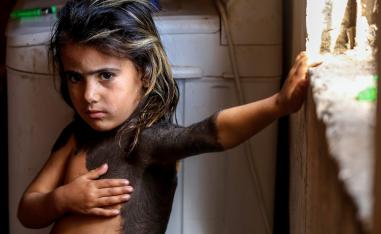 شامة عملاقة على جسد طفلة عراقية