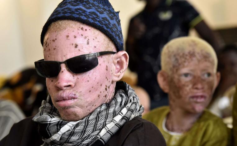 أشخاص من السنغال مصابون بأمراض جلدية
