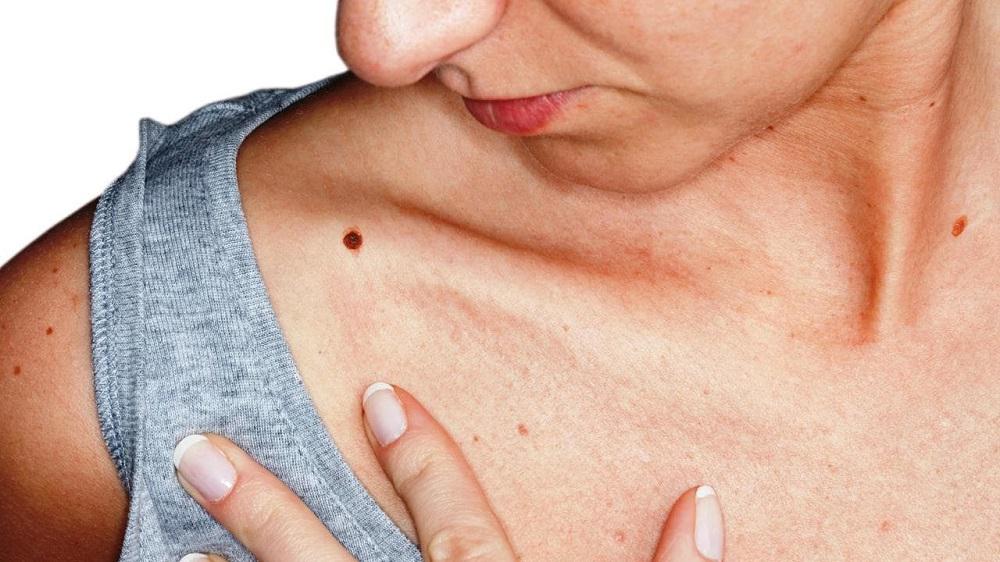 مضاد حيوي للالتهاب المعوي يقهر أشرس سرطانات الجلد