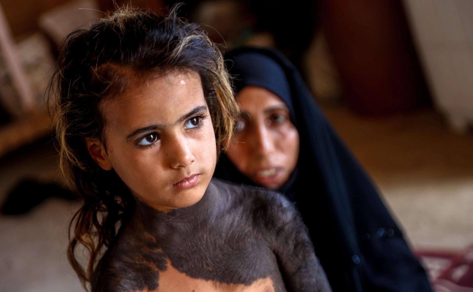 الامراض النادرة