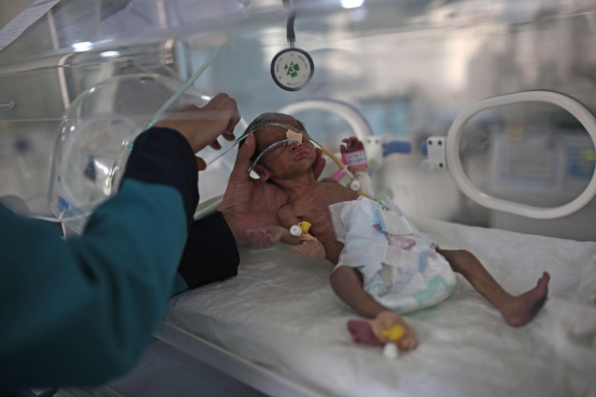 الموت يحيط بأطفال اليمن بسبب سوء التغذية والمرض
