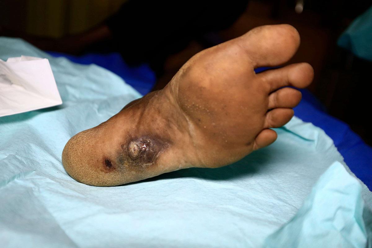 قدم مريض سوداني مصاب بالمايستوما 