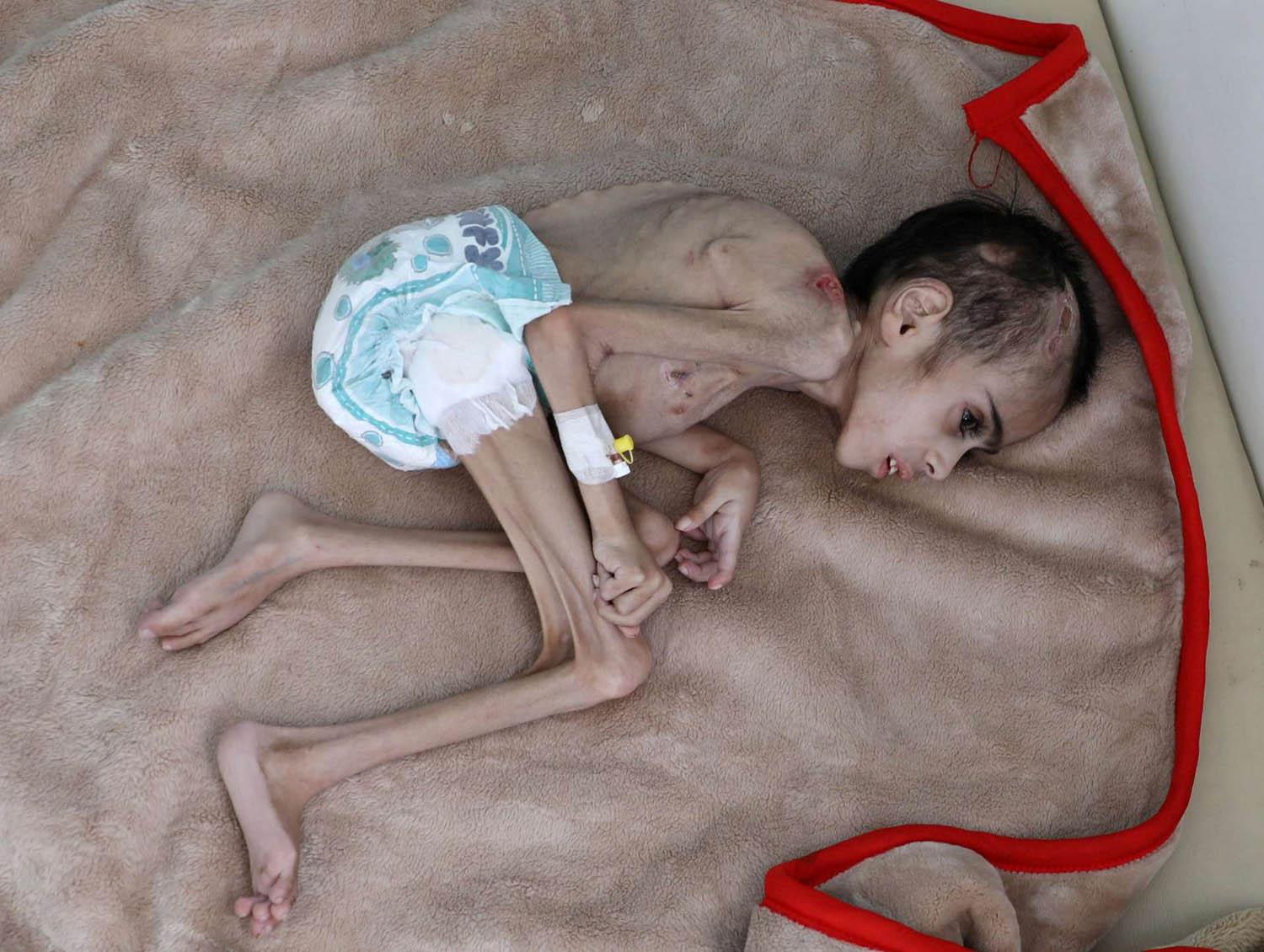 طفل يمني مصاب بنقص التغذية في مستشفى في صنعاء