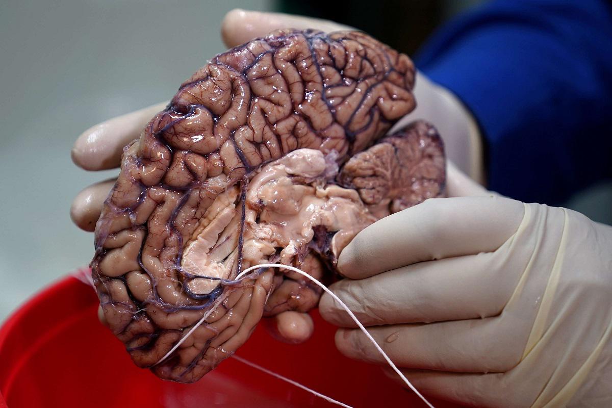 طبيب يحمل دماغًا بشريًا في بنك للأدمغة في نيويورك