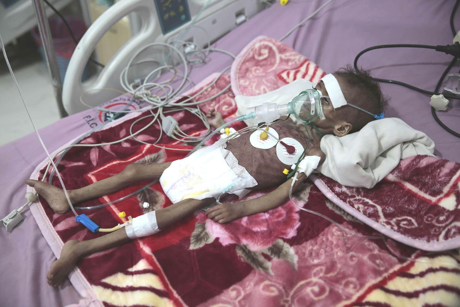 طفلة يمنية تعاني من سوء التغذية في مستشفى في صنعاء