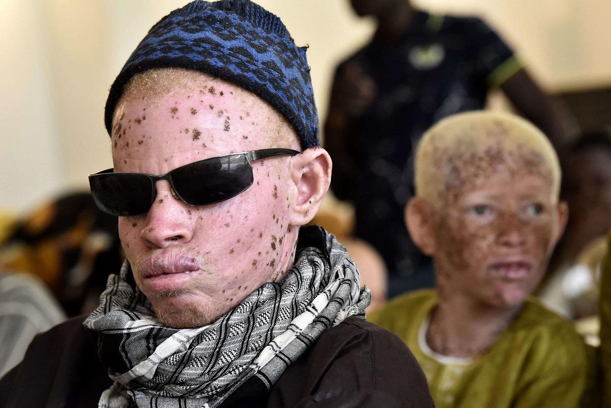 أشخاص من السنغال مصابون بأمراض جلدية