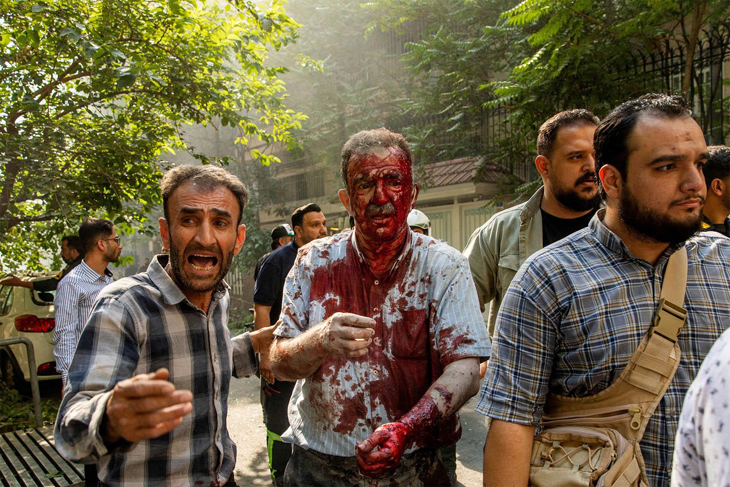 A wounded man reacts following the Israeli strikes on Tehran